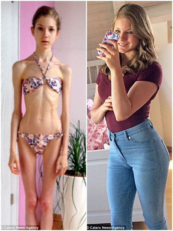 анастасия соломатина анорексия