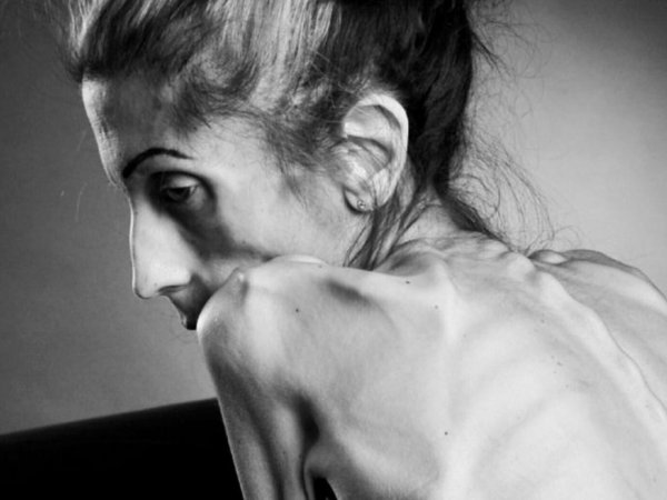 анорексичная кахексия