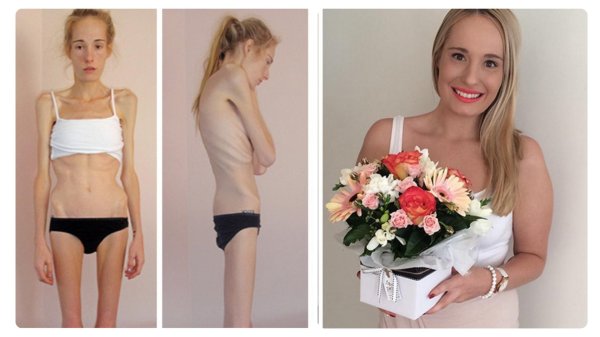 люди болеющие анорексией