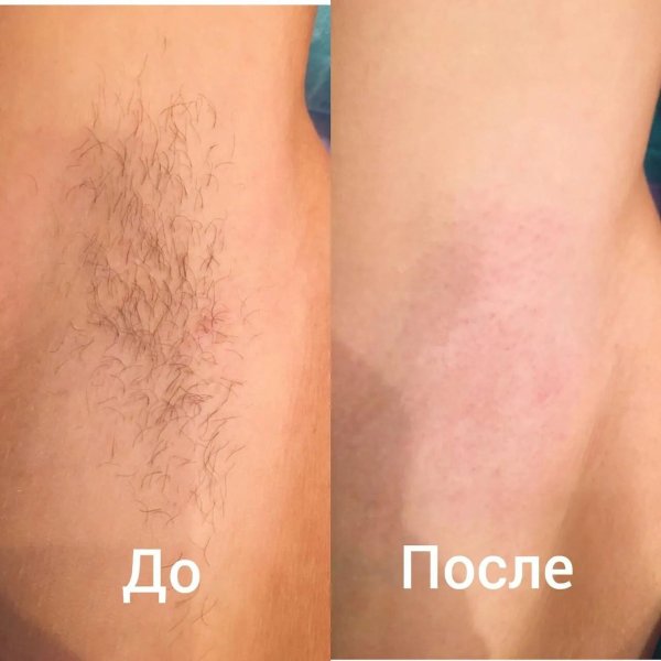 до после лазерная эпиляция