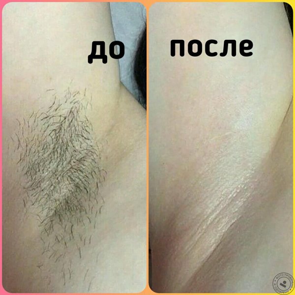 до и после лазерной эпиляции