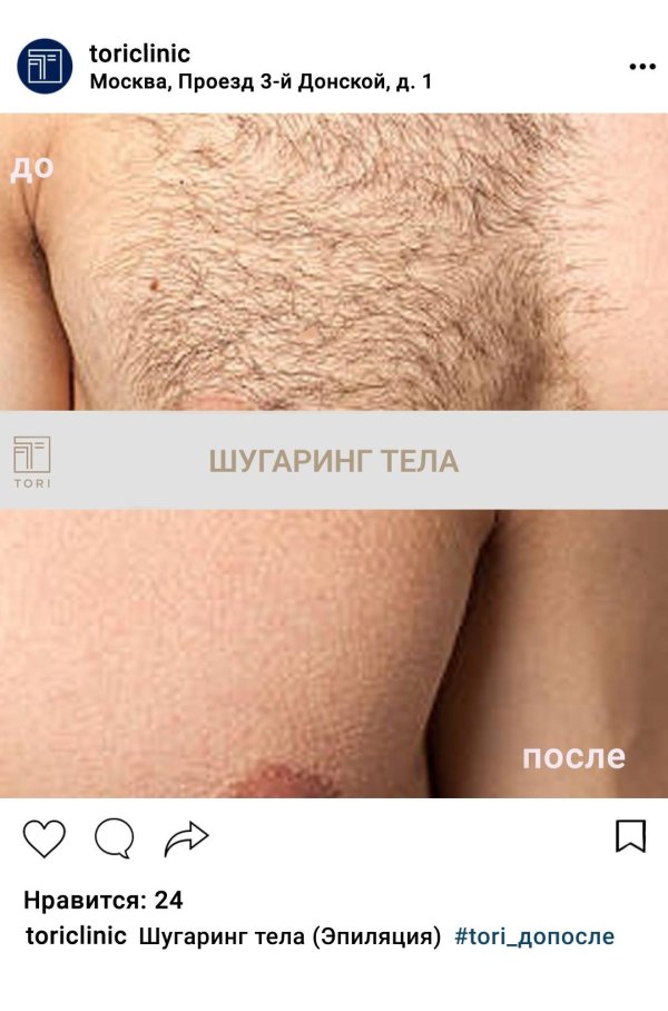 эффект после 1 процедуры лазерной эпиляции бикини
