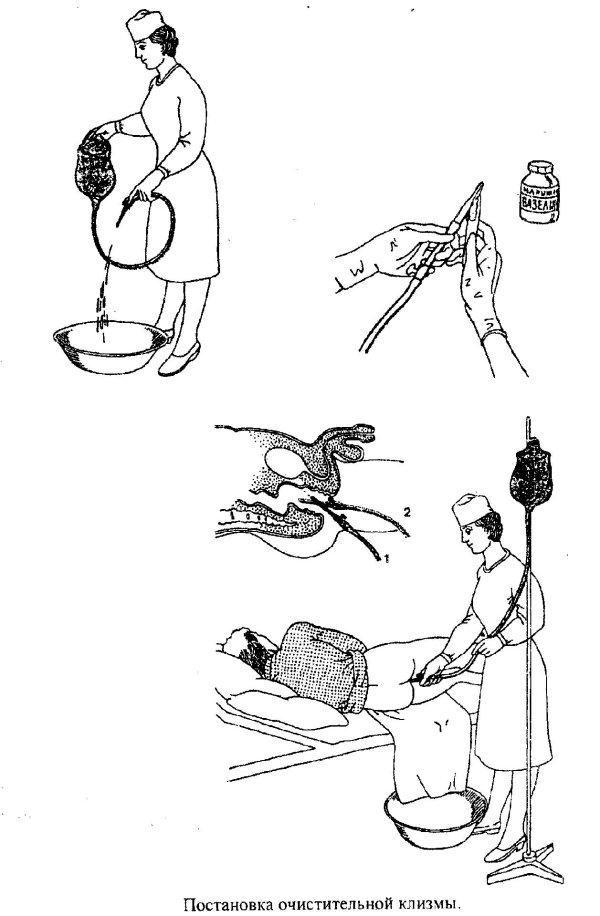 методика постановки очистительной клизмы