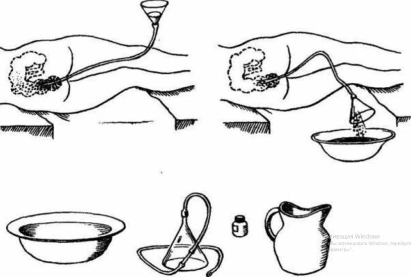 постановка сифонной клизмы алгоритм