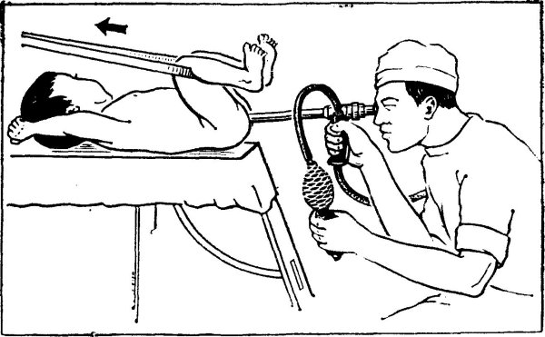 ректороманоскопия техника показания