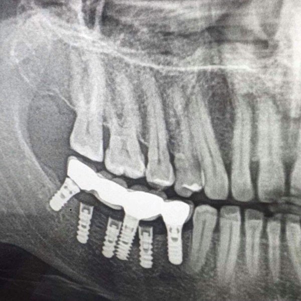 зигома импланты